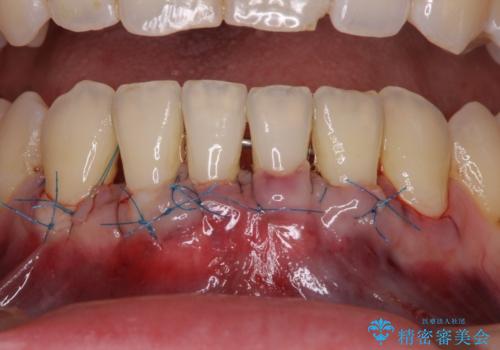 下顎前歯の歯肉退縮 歯肉移植による根面被覆の治療中