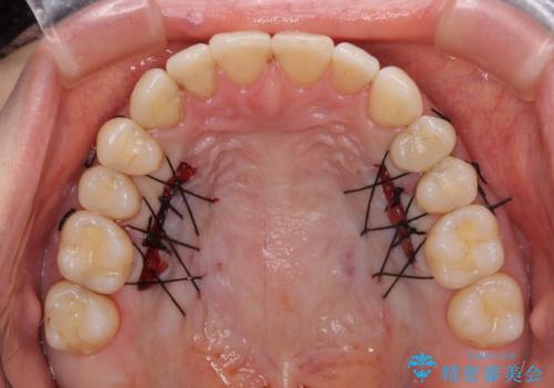 下顎前歯の歯肉退縮　歯肉移植による根面被覆の治療中