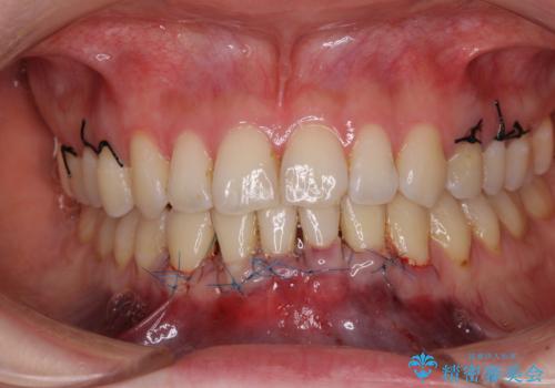 下顎前歯の歯肉退縮 歯肉移植による根面被覆の治療中