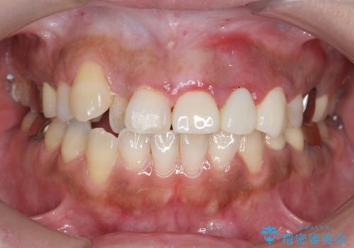 オールセラミッククラウン 根管治療のやり直しの治療前