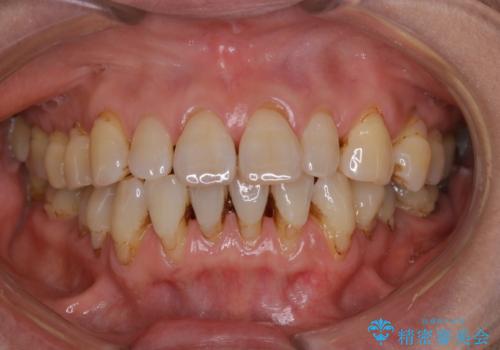 PMTC60分コースで取れるだけステイン落としの治療前