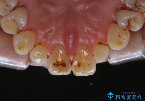PMTC60分コースで取れるだけステイン落としの治療前