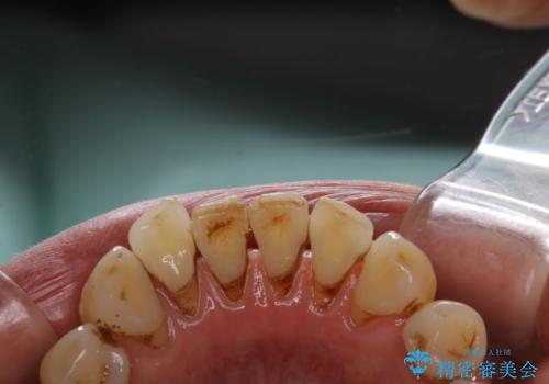 PMTC60分コースで取れるだけステイン落としの治療前