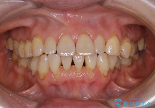 PMTC60分コースで取れるだけステイン落としの治療後