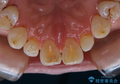 PMTC60分コースで取れるだけステイン落としの治療後