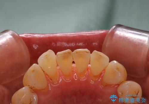 PMTC60分コースで取れるだけステイン落としの治療後