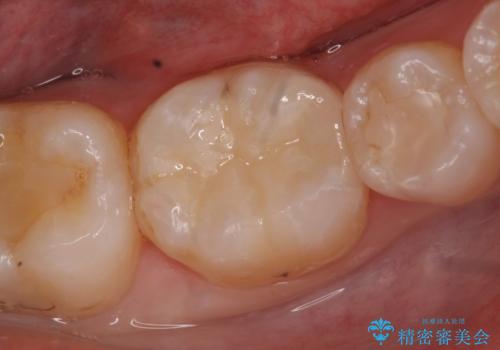 セラミックインレー　銀歯から白い歯への症例 治療後