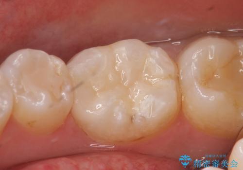 セラミックインレー　銀歯から白い歯への治療後