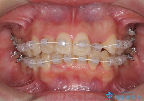 短期間で終了 デコボコをワイヤー矯正で解消の治療中