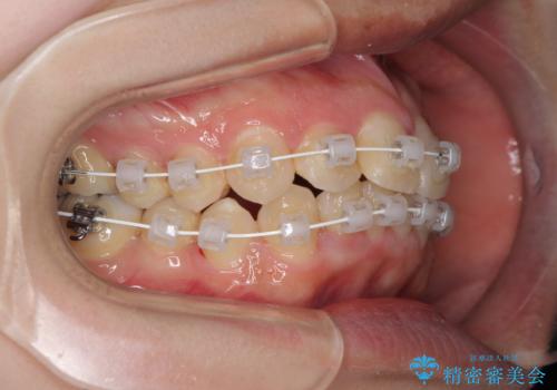 短期間で終了 デコボコをワイヤー矯正で解消の治療中