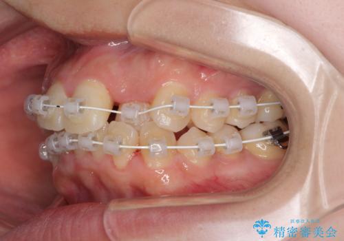 短期間で終了 デコボコをワイヤー矯正で解消の治療中