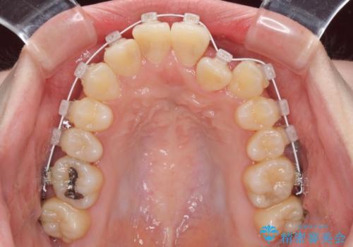 短期間で終了 デコボコをワイヤー矯正で解消の治療中