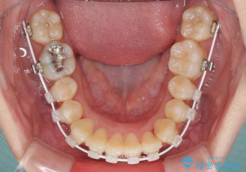 短期間で終了 デコボコをワイヤー矯正で解消の治療中