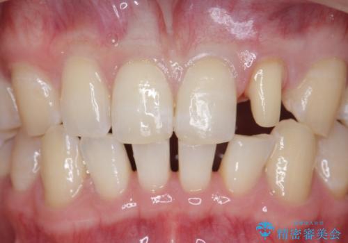 オールセラミッククラウン 部分矯正の治療中