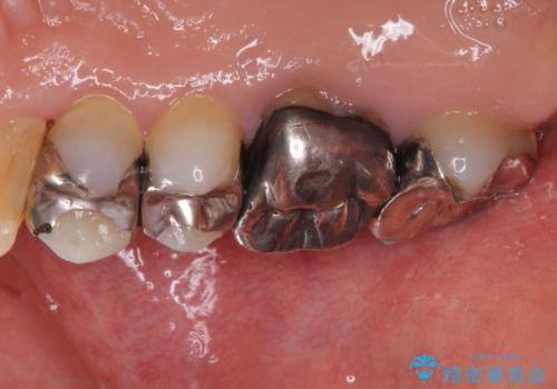 痛くてかめない 根管治療とオールセラミッククラウンの治療前