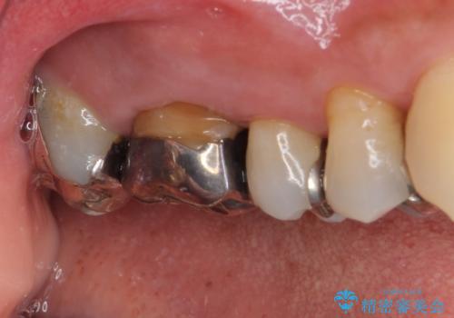 痛くてかめない 根管治療とオールセラミッククラウンの治療前