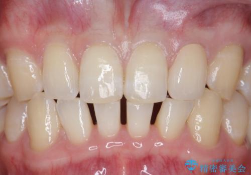 オールセラミッククラウン 部分矯正の治療後