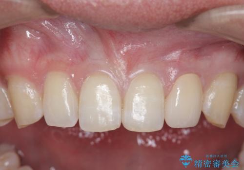オールセラミッククラウン 部分矯正の症例 治療後