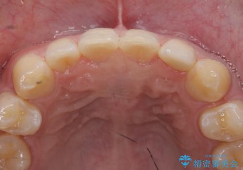 オールセラミッククラウン 部分矯正の治療後