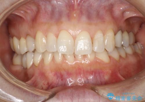 PMTCで歯と歯の間の細かいステインの除去の治療後
