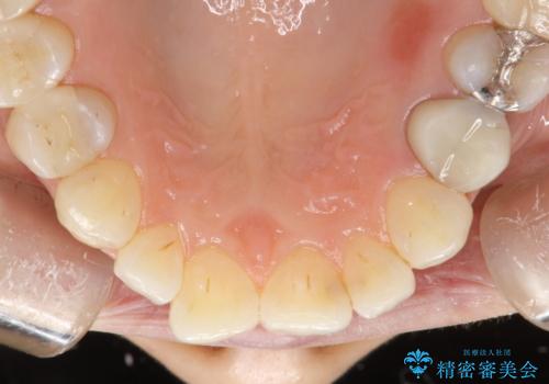 PMTCで歯と歯の間の細かいステインの除去の治療後