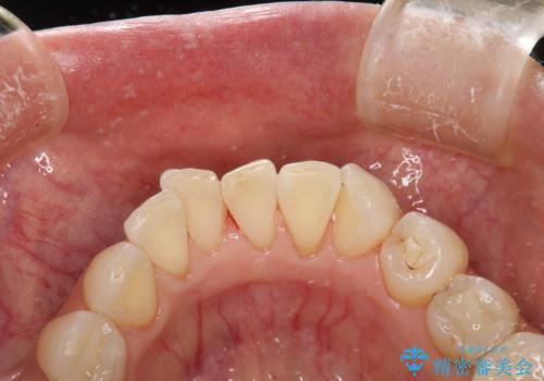 PMTCで歯と歯の間の細かいステインの除去の治療後