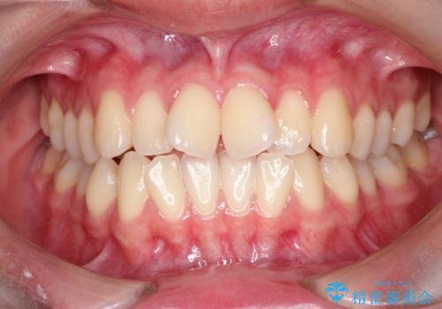 インビザラインによる非抜歯矯正 ガタガタな歯並びを整った歯並びへ