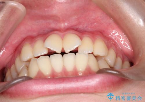インビザラインによる非抜歯矯正 ガタガタな歯並びを整った歯並びへの治療前