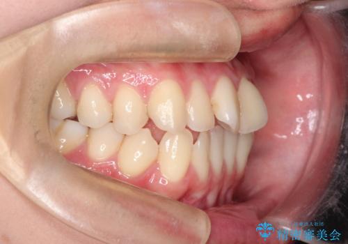インビザラインによる非抜歯矯正　ガタガタな歯並びを整った歯並びへの治療前