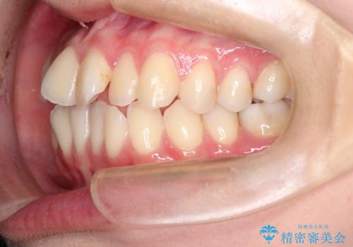 インビザラインによる非抜歯矯正 ガタガタな歯並びを整った歯並びへの治療前