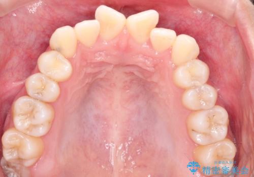 インビザラインによる非抜歯矯正 ガタガタな歯並びを整った歯並びへの治療前
