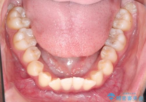 インビザラインによる非抜歯矯正 ガタガタな歯並びを整った歯並びへの治療前