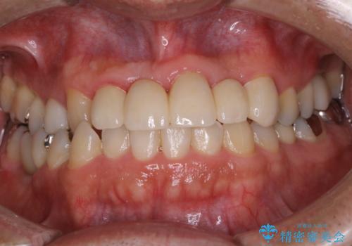 歯科衛生士によるPMTCでお口のケアの治療前