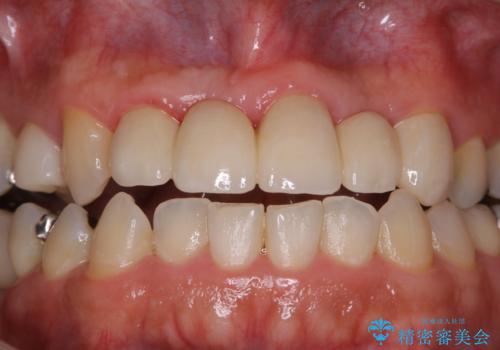 歯科衛生士によるPMTCでお口のケアの症例 治療前