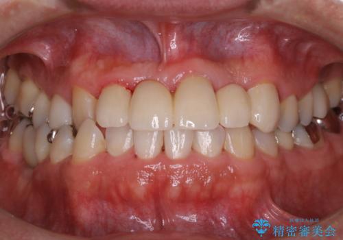 歯科衛生士によるPMTCでお口のケアの治療後