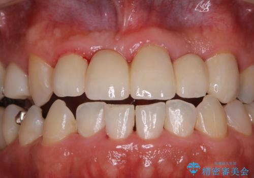 歯科衛生士によるPMTCでお口のケアの症例 治療後