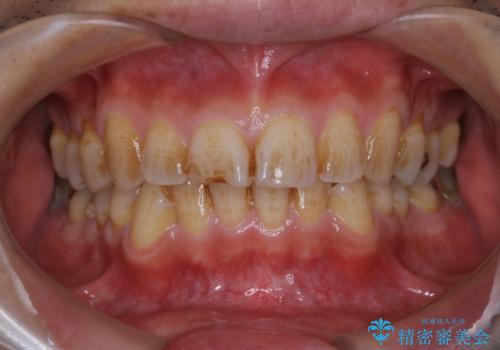 しつこい歯の着色をPMTCで1日でピカピカにの治療前