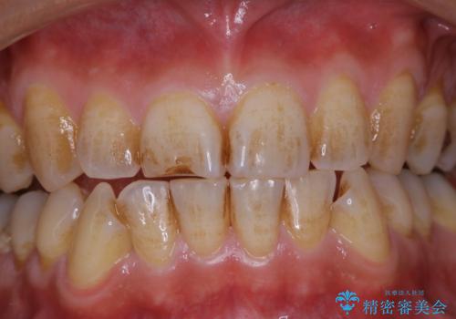 しつこい歯の着色をPMTCで1日でピカピカに