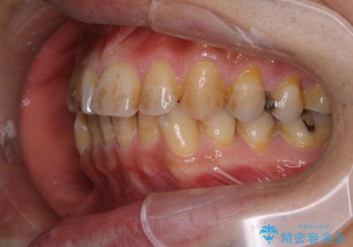 しつこい歯の着色をPMTCで1日でピカピカにの治療前