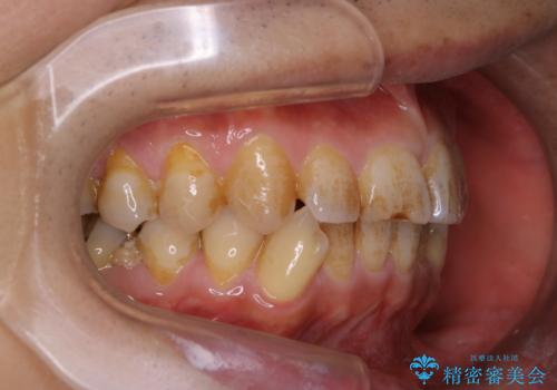 しつこい歯の着色をPMTCで1日でピカピカにの治療前