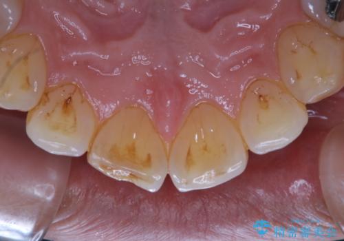 しつこい歯の着色をPMTCで1日でピカピカにの治療前