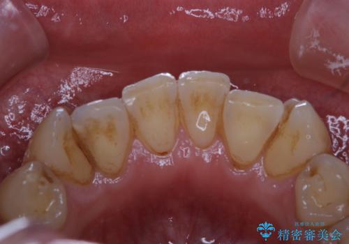 しつこい歯の着色をPMTCで1日でピカピカにの治療前