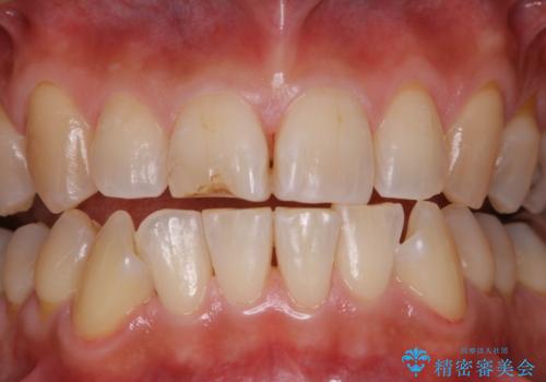 しつこい歯の着色をPMTCで1日でピカピカにの治療後