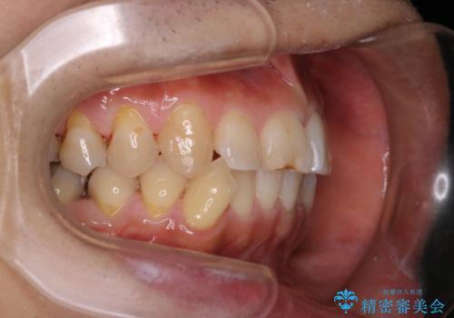 しつこい歯の着色をPMTCで1日でピカピカにの治療後