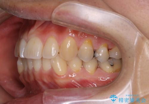 しつこい歯の着色をPMTCで1日でピカピカにの治療後