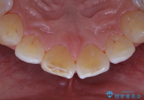 しつこい歯の着色をPMTCで1日でピカピカにの治療後
