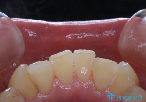 しつこい歯の着色をPMTCで1日でピカピカにの治療後