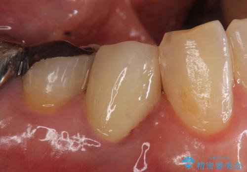 オールセラミッククラウン　再根管治療後の補綴の治療後
