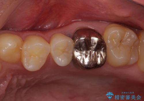 銀歯を白くしたい セラミックによる審美歯科治療の治療前