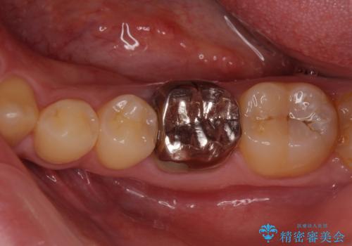 銀歯を白くしたい セラミックによる審美歯科治療の治療前